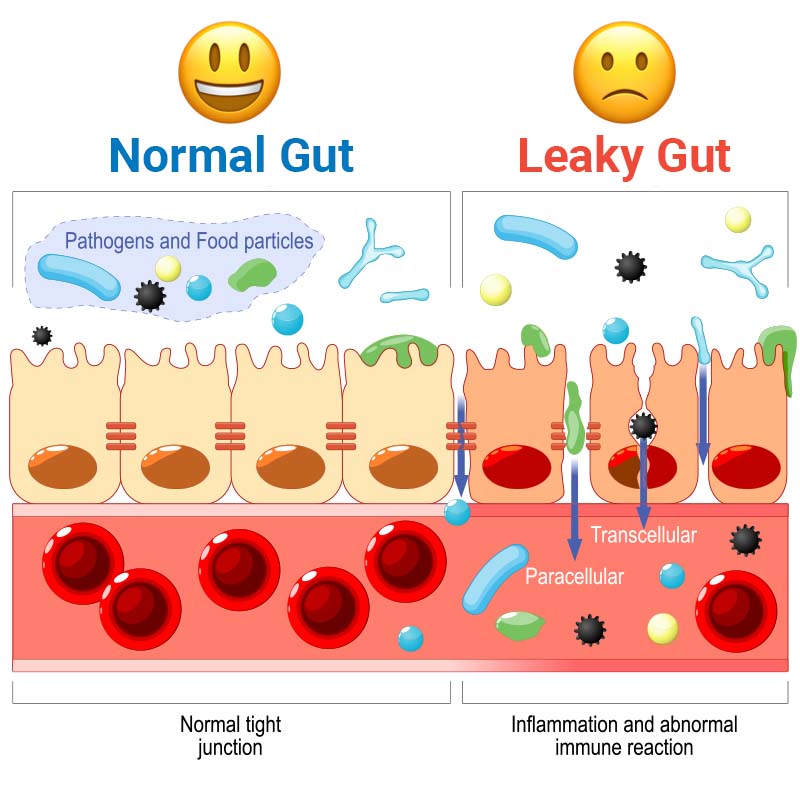 Leaky Gut